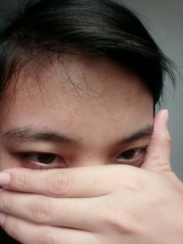 额头上长很多小疙瘩 疑似脂肪粒 请问是什么?