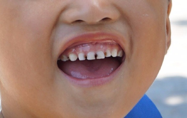 小孩牙龈发黑发紫图片图片