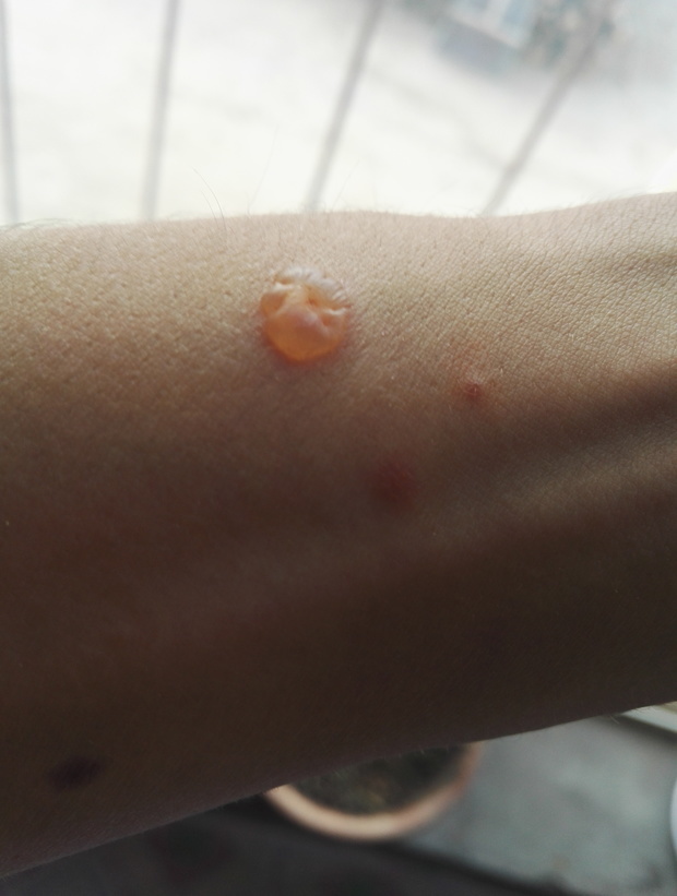 水泡,一天以后挑破了,留出淡黄色的液体是啥东