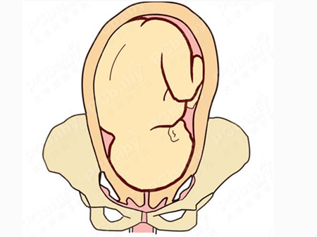 胎兒臀位頭在哪裡