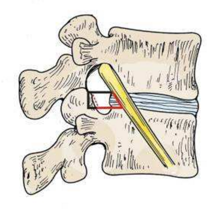 椎间孔的构成图片
