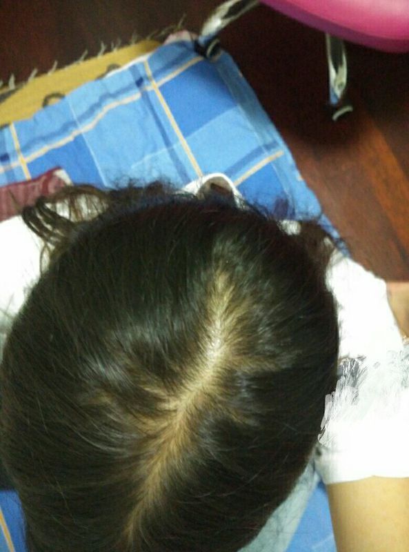 才18岁,掉发很厉害,也会干枯分叉,现在头发越来越少了,如图.