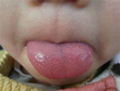 小儿草莓舌头图片图片
