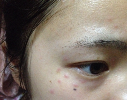 问: 问:眼睛周围长红色痘痘了,昨天起来发现痘痘更多了,围着眼睛周围