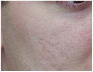 毛孔粗大,这个是毛囊虫引起的吗(如图)