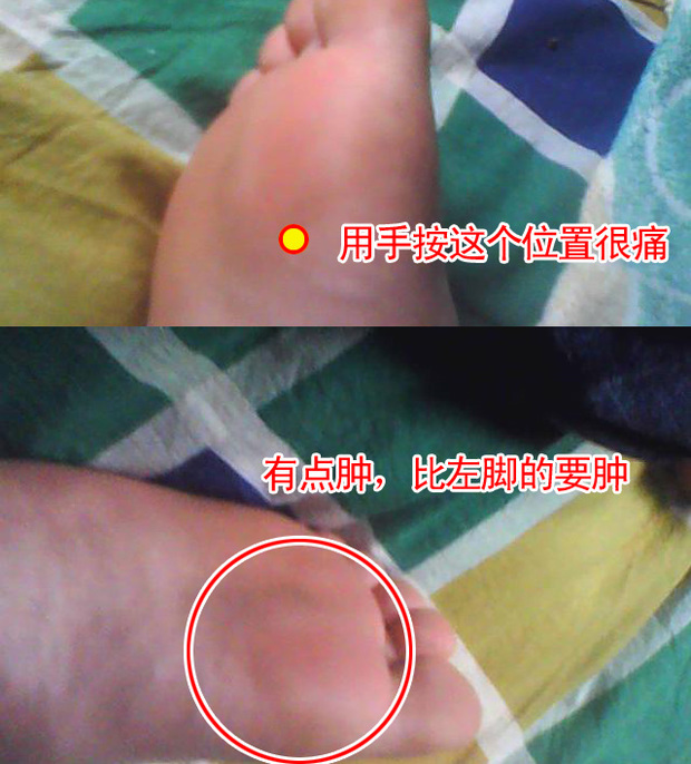右脚大母脚趾根部(大母脚趾根部那个凸起的骨头位置)很痛,这个凸起的