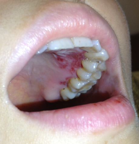 是溃疡还是感染?急