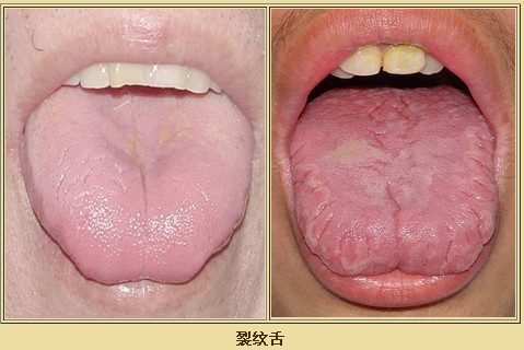 望舌的如何观察和分析舌象