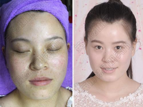 英涛祛斑排色期一瓶塑颜液要几次用