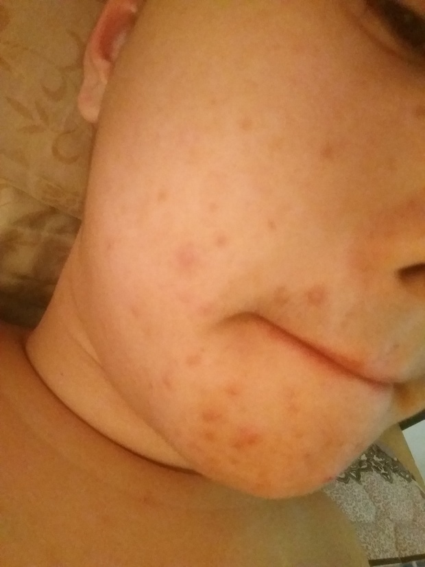 以前不洗脸都不长痘,现在洗脸反而长了很多很