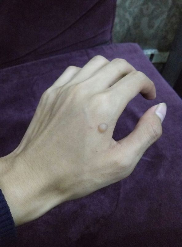 手被油烫出了个泡 到底用不用挑破 说明一下为什么