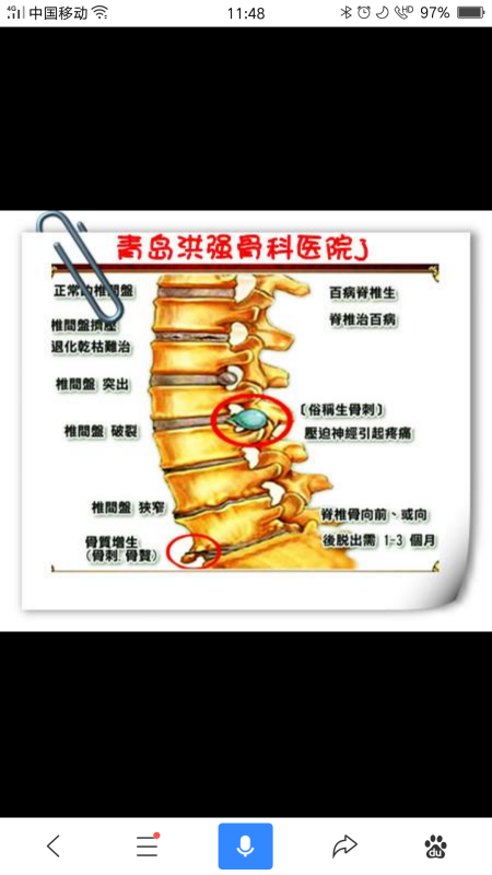 骨质增生是怎么形成的,它的病因是什么?