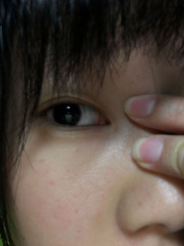 左右眼眼角有一坨小小的粉色的肉是怎么了?正常吗?