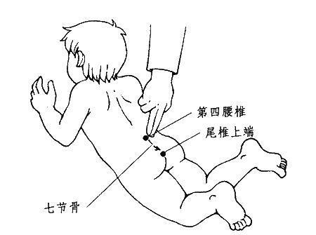 小儿蛔虫性肠梗阻推拿方法