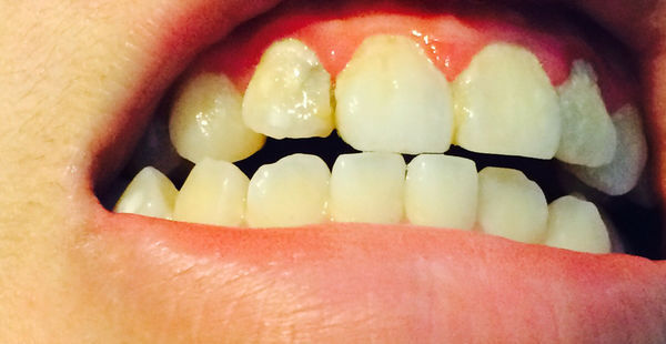 门牙三年前树脂补过的牙缝现在又出现了一个缝