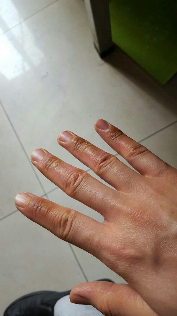 手被开水烫起水泡,前天我干活的时候有不小心破了