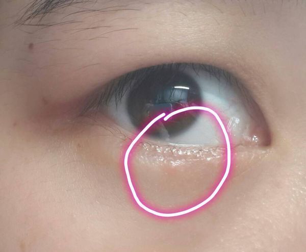 右眼下眼睫毛下面长了个有点红红的小肉粒,不痛不痒,照片照起来没那么
