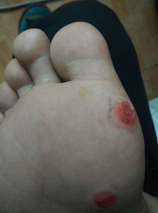 已用水杨酸苯酚贴膏,已贴了4天 接下来还贴吗 还有4个小的怎么办啊