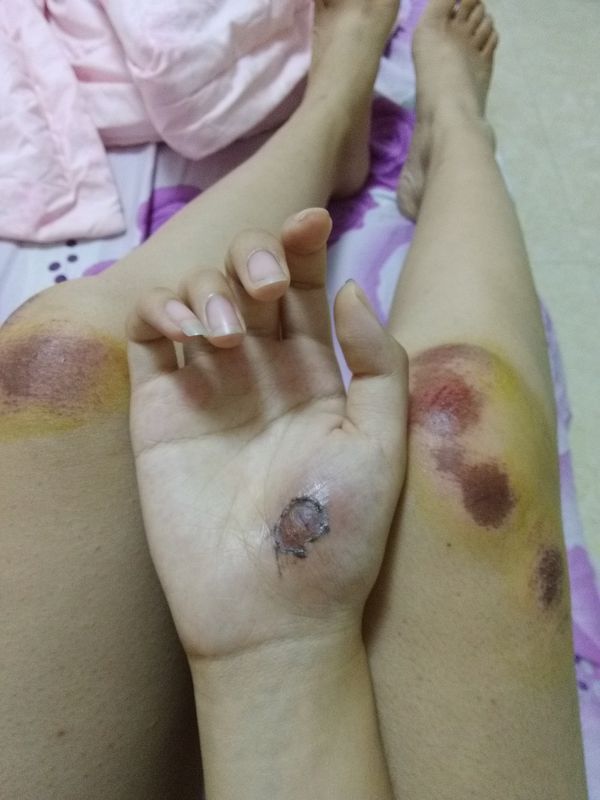 今天中午时候摔的,用双氧水消了毒,然后还抹了