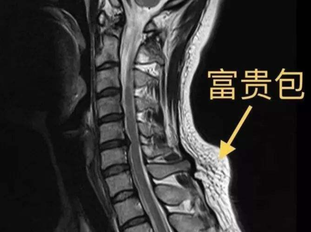 擴展資料: 富貴包的危害: 富貴包不等於頸椎病,但通常會影響頸椎疾病