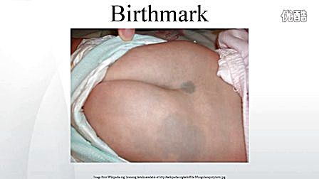 Birthmarked