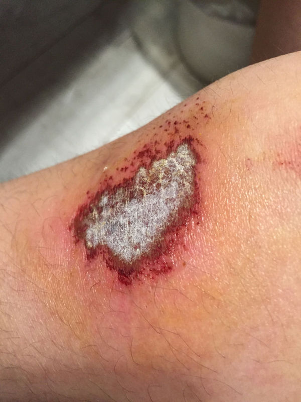 皮肤擦伤了,涂了碘酒和百得邦以后伤口干燥发白,这样正常吗?