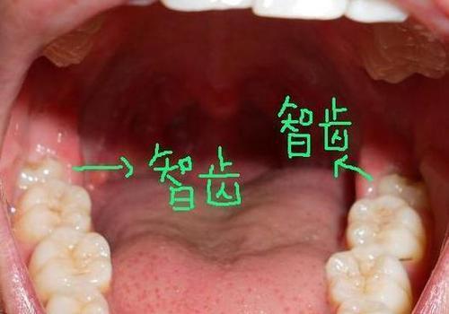 智齒拔掉會有什麼影響麼?