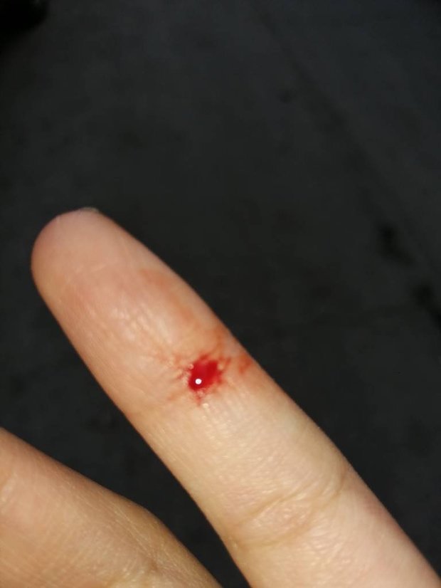 手指被割伤,现在又疼又痒.