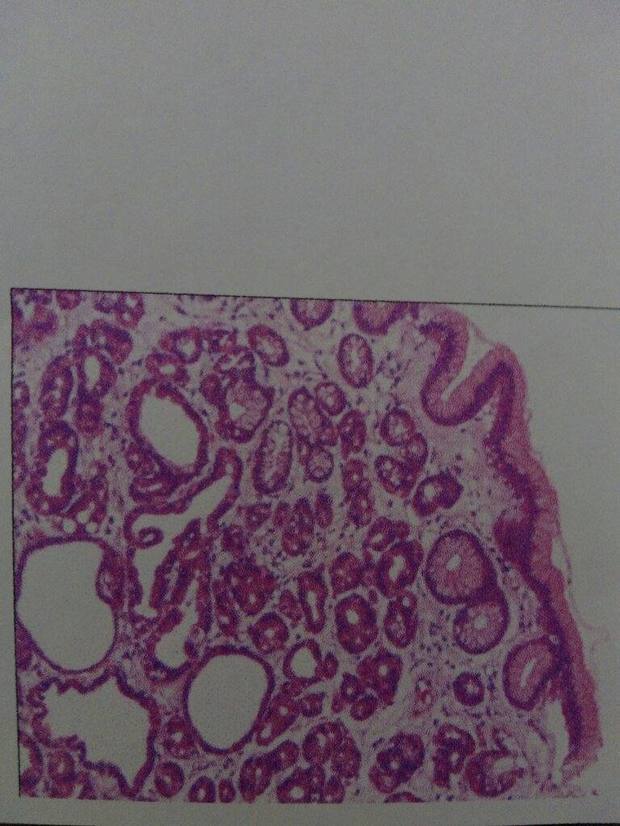 这个是胃息肉病理切片,有谁是病理科的,会看这是什么性质的息肉.