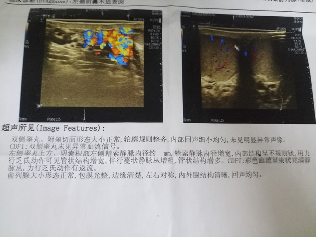 医生说我的是左侧精索静脉曲张,假如我不想要