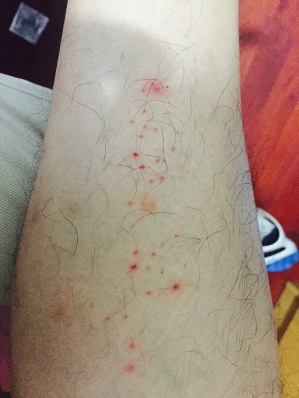 夏天被蚊子咬过之后抓破后这样了,两个小腿都