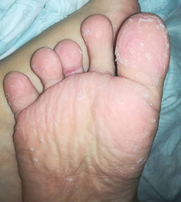 每次洗完澡脚底都会脱皮成这样