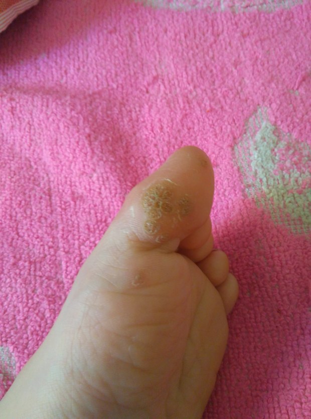 求治疗 疣 的方法 我儿子9岁。左脚大拇指。冷