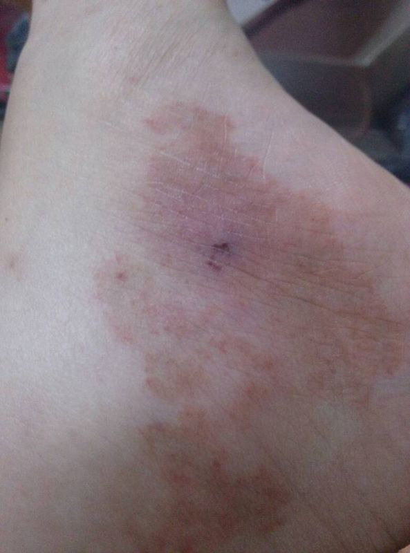 小腿和脚上起这样的红色血点斑,不痛不痒不凸