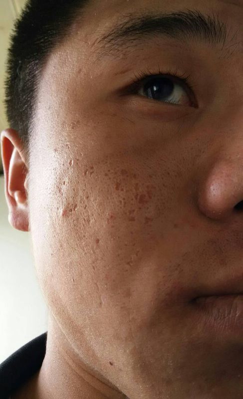 脸上长痘痘,有黑斑,有痘印怎么处理?