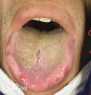 尿毒症的舌苔图片图片