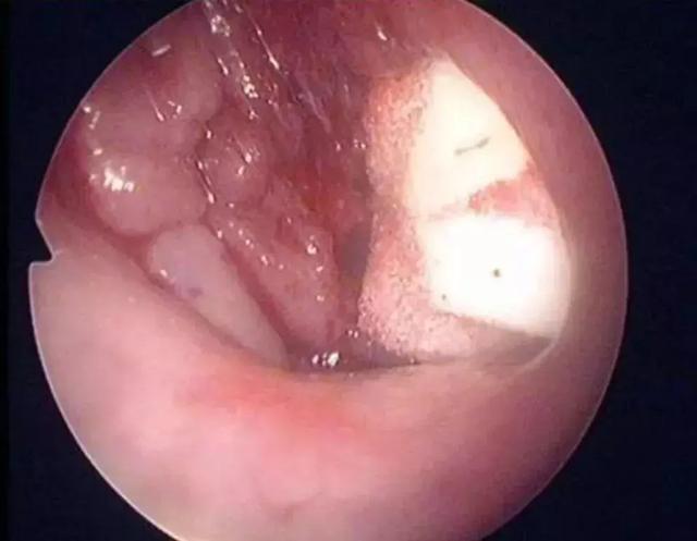 当呼吸通道被这样堵塞住,自然会呼吸不畅了,孩子为了满足身体的需要