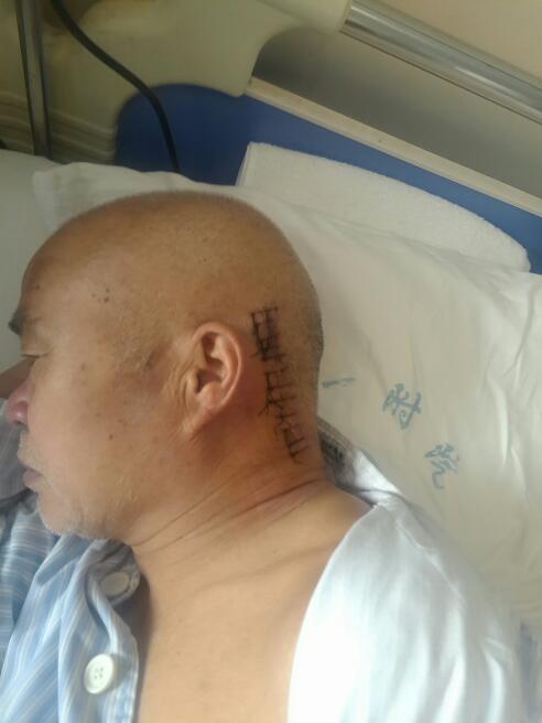 患有神经面肌挛,你们医院是不是可以做微创手