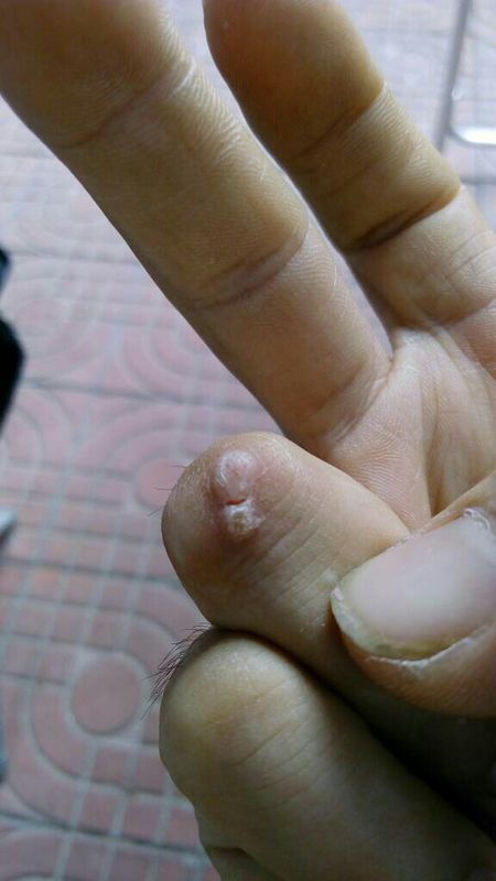 这刺猴怎样去掉