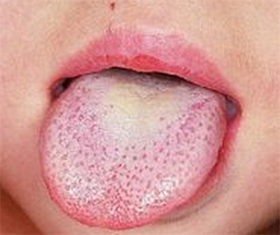 小孩草莓舌多久能好?