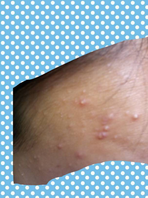 青春期这种痘怎么去除 总是大片大片的长 很恶