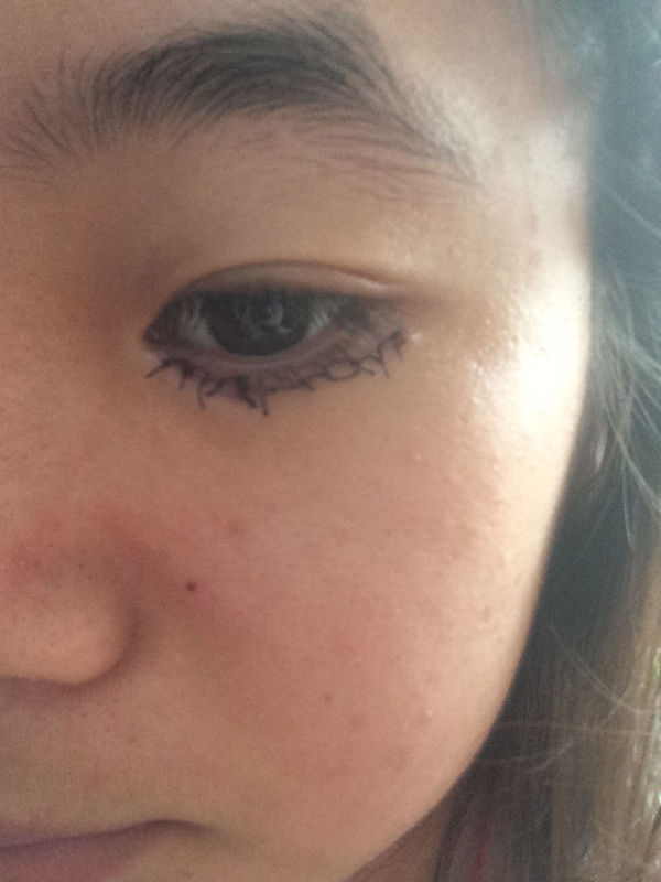 想问大家 我这是刚做完倒睫手术两三天 脸一直都是肿的 重一点闭眼睛