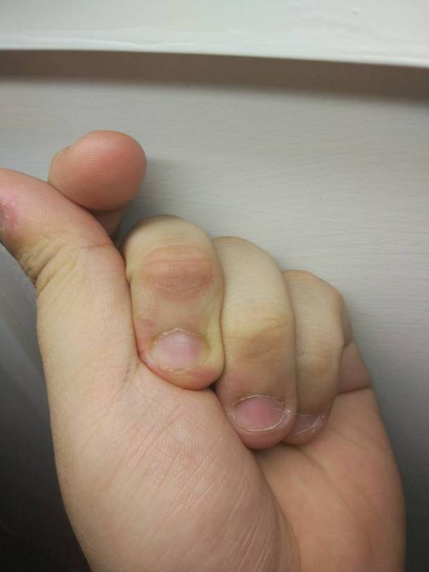 手指头发麻 关节处发黑