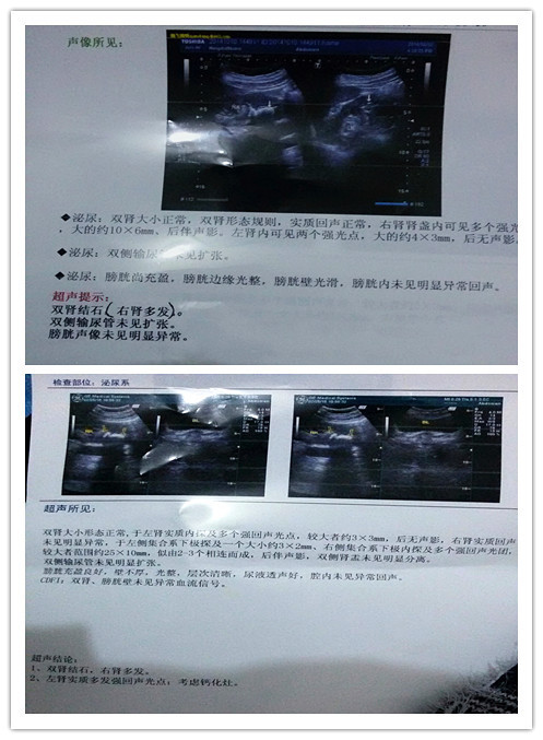 想问一下医生网友肾结石与钙化灶是什么关系?