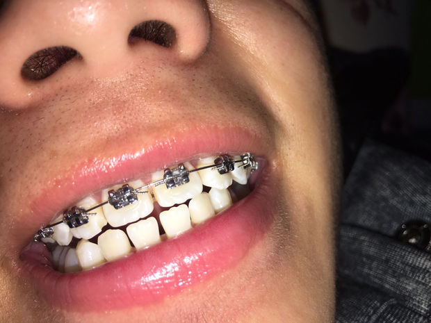 牙套固定绳子上的点是什么