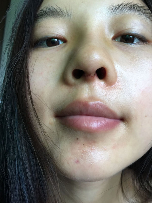 隆鼻后鼻孔不一样是什么原因会导致的?而且右