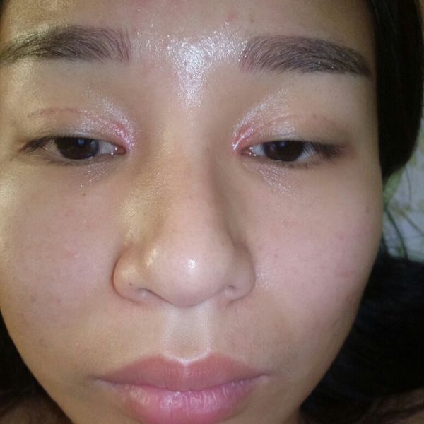 做了双眼皮2个半月眼角那里硬硬的,还开了眼角的?