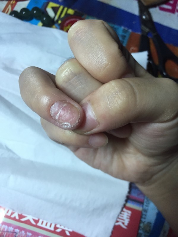 这个指甲是灰指甲么 这个样子好多年了 一直坑坑洼洼有白色的东西