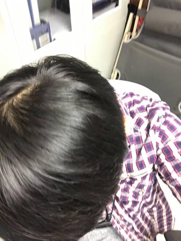 头顶发量正常吗(洗澡的时候掉挺多头发的,平时弄头发的时候,我会掉几