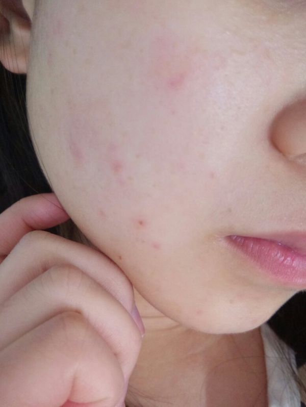 左脸突然长了很多这样的痘痘,还有点痒,怎么办?